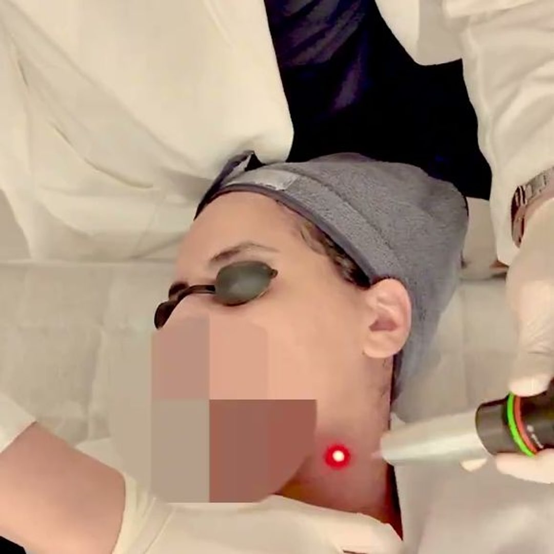 레이저 시술을 받는 장면으로, 얼굴은 원본에서 모자이크 처리돼 있습니다